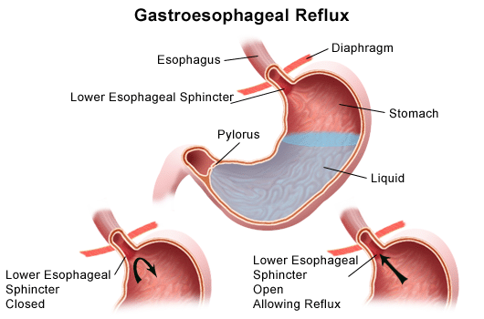 called GERD (gastroesophageal reflux disease) . It occurs when acid 