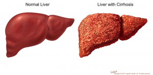 Liver Cirrhosis
