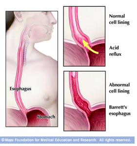 Barrett's Esophagus