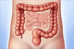 Ulcerative colitis