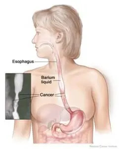 Barium Swallow