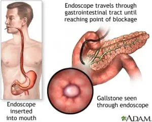 ERCP