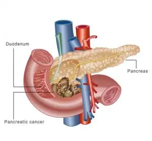 Pancreatic Cancer