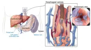 Esophageal varices