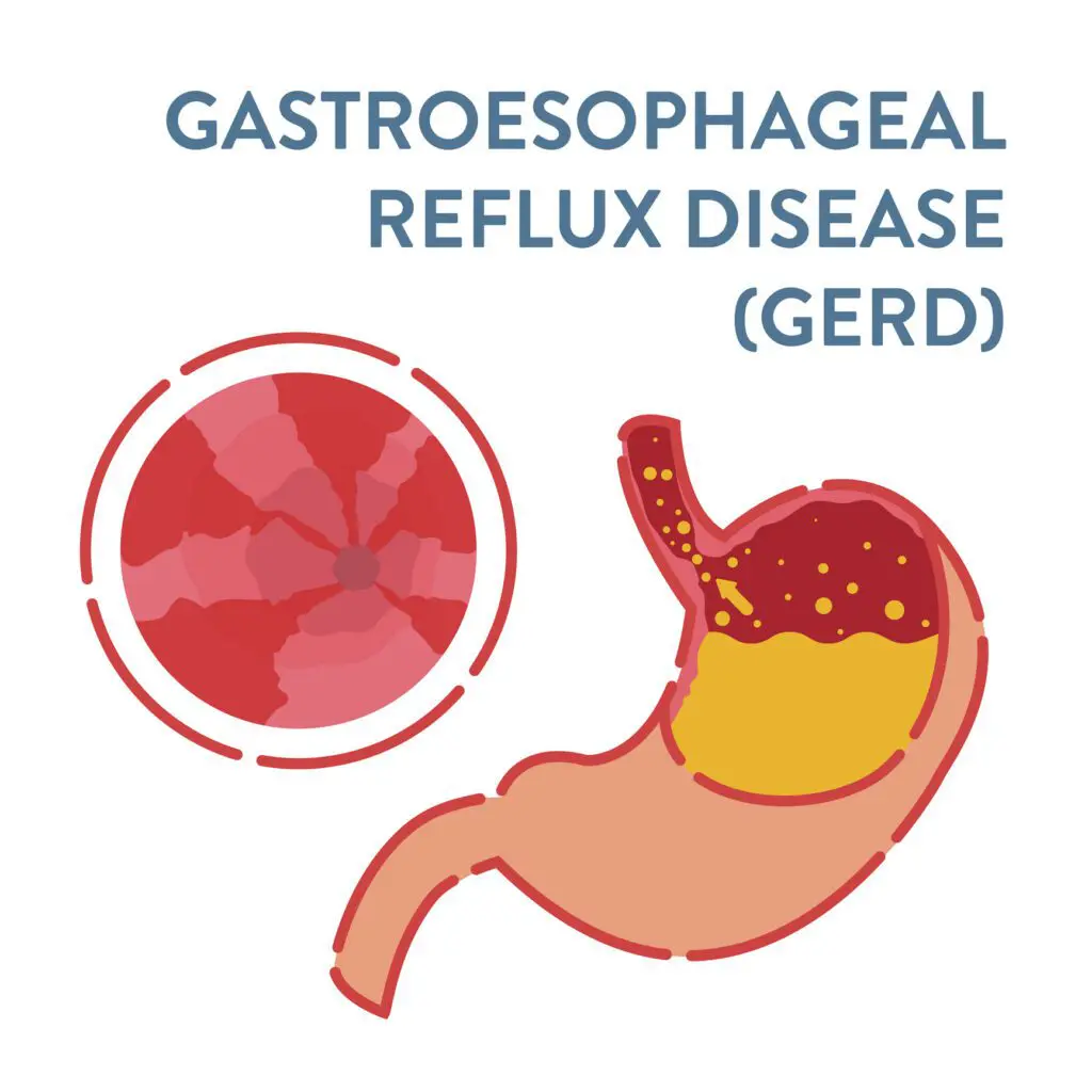 gastroesophageal reflux disease