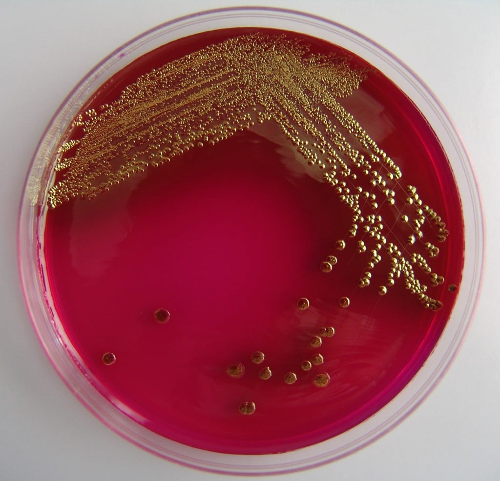 Escherichia Coli Infection (E. Coli)