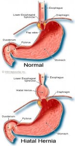 Hiatal hernia