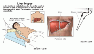 Liver-biopsy
