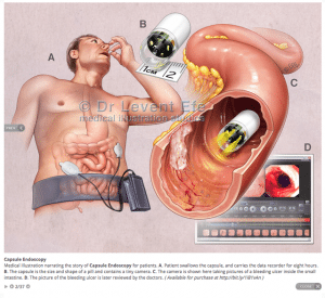 Capsule Endoscopy