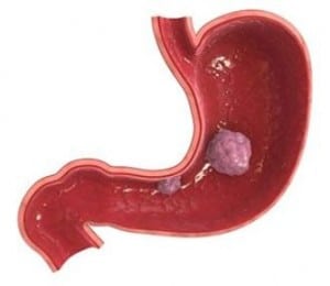 Stomach Cancer