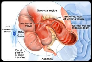Illustration-of-crohns-disease