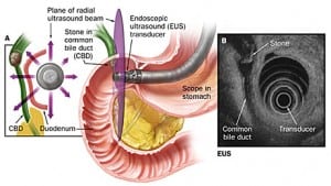 Endoscopic Ultrasconography Rectum/Colon (EUS)