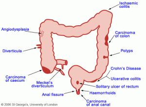 gastrointestinal (GI) bleeding