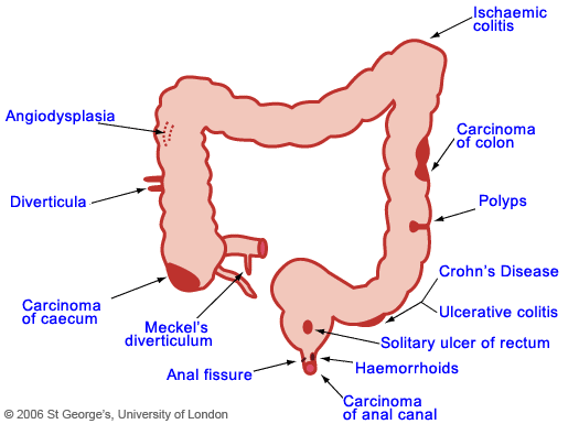 gastrointestinal (GI) bleeding - Suburban Gastroenterology of