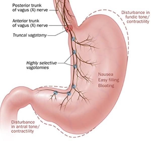 gastroparesis doctor near me