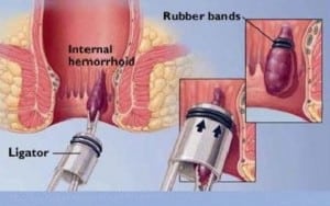 Hemorrhoid Banding procedure