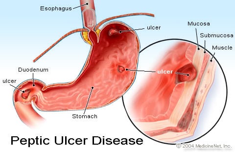 Is Stomach Ulcer Pain Worse At Night
