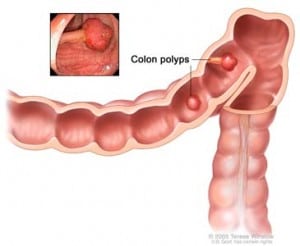 Colon + Rectal Polyps