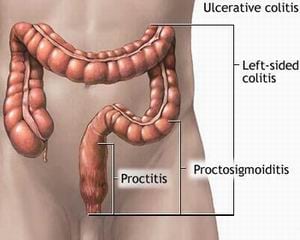 Proctitis