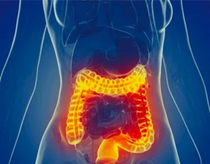 Inflammatory Bowel Disease (IBD)